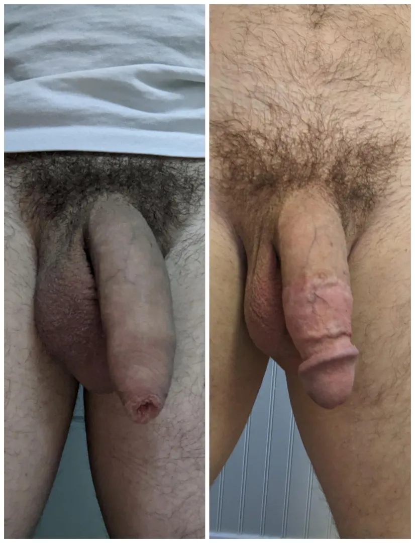 Before and After my Circumcision. Happy to answer questions. DMs open