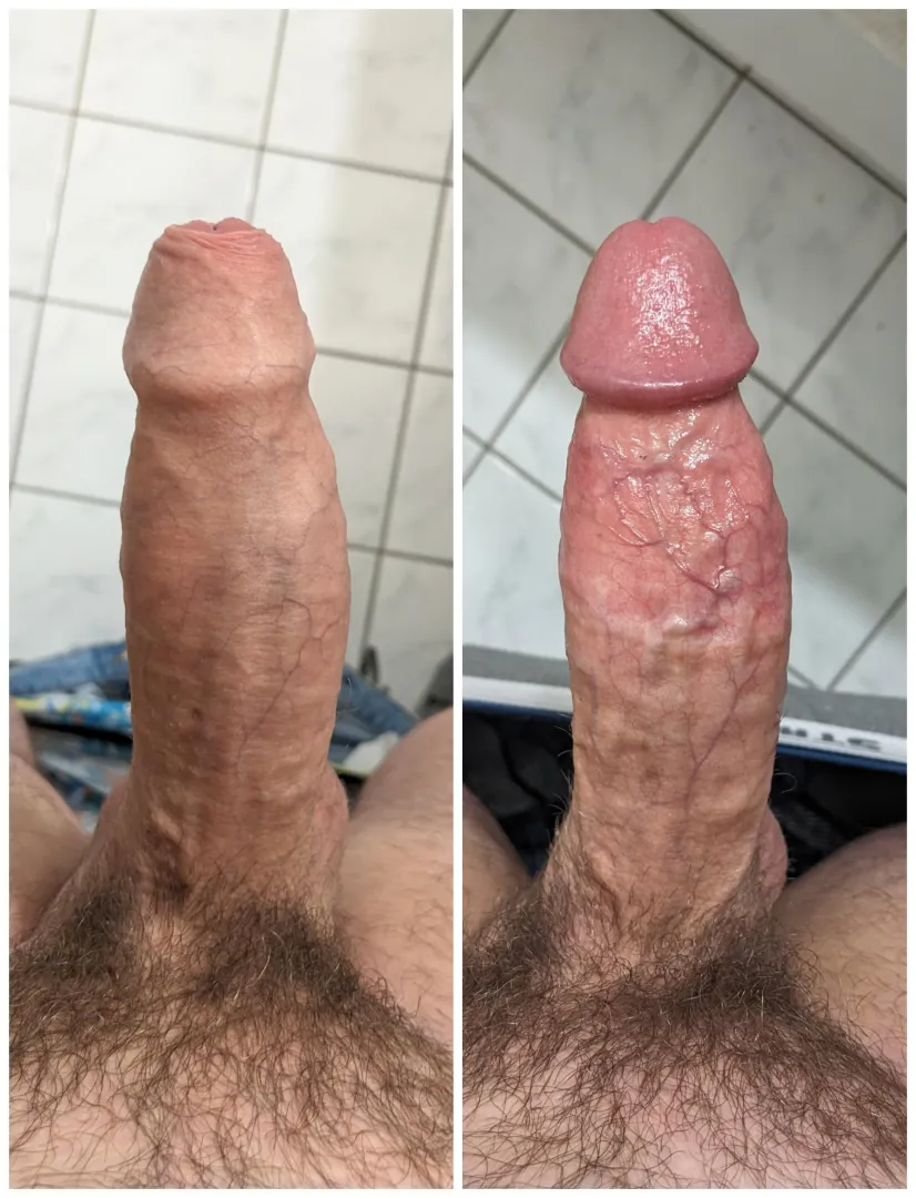 Before and After my Circumcision. Happy to answer questions. DMs open
