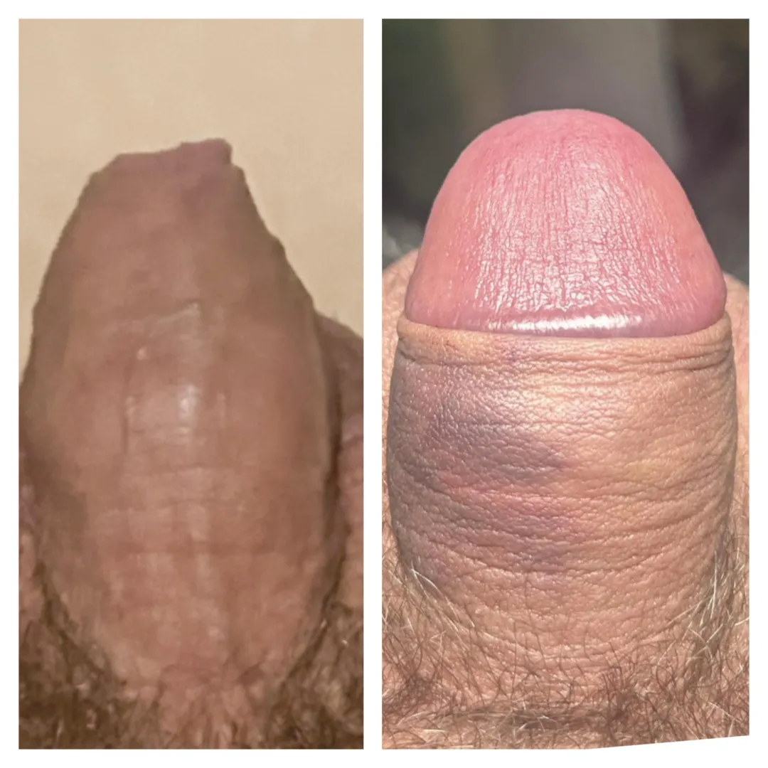 2 days either side of op. How’s it looking?