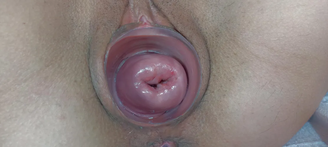 Cervix sin control