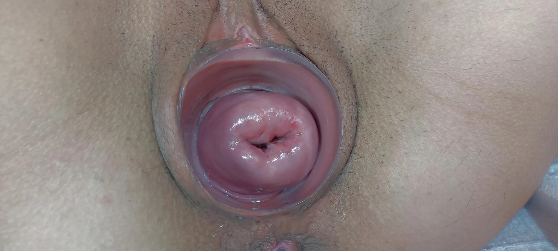 Cervix sin control