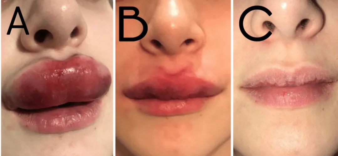 Obstruction of labial venous drainage following injection of hyaluronic acid fillers. After treatment with high-dose pulsed protocol with 1,500 IU of hyaluronidase and prednisone, the swelling went down.