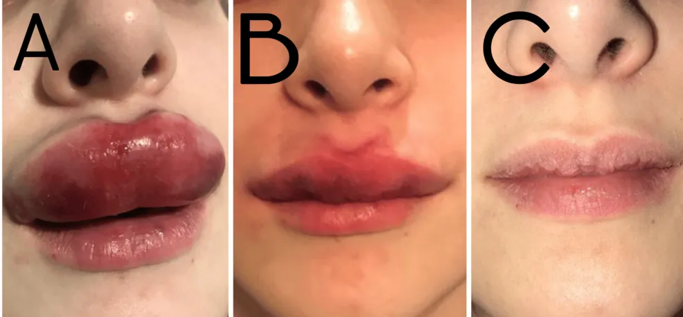 Obstruction of labial venous drainage following injection of hyaluronic acid fillers. After treatment with high-dose pulsed protocol with 1,500 IU of hyaluronidase and prednisone, the swelling went down.