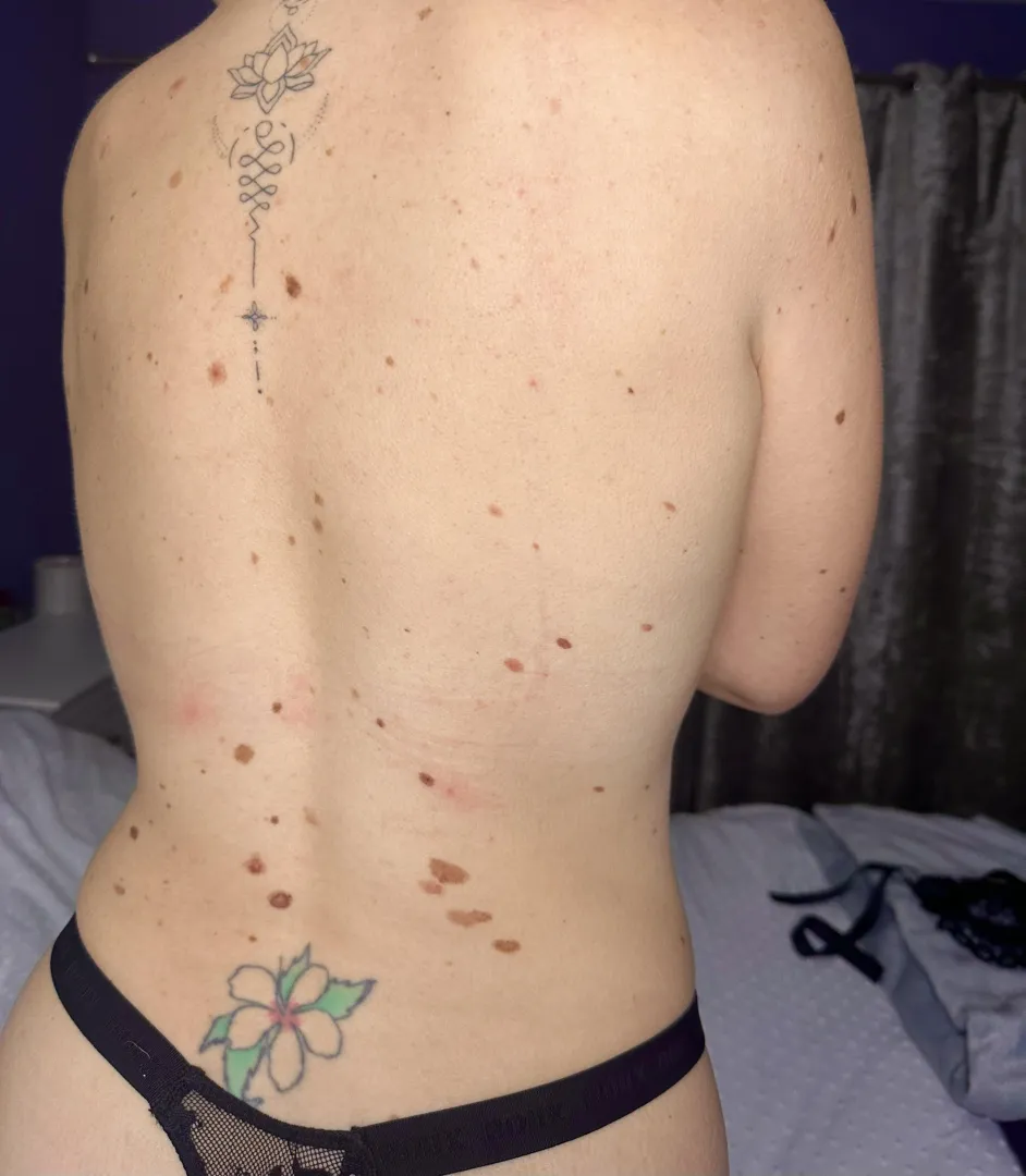 You’re helping me like my moles more! Sorry about the bra strap marks..